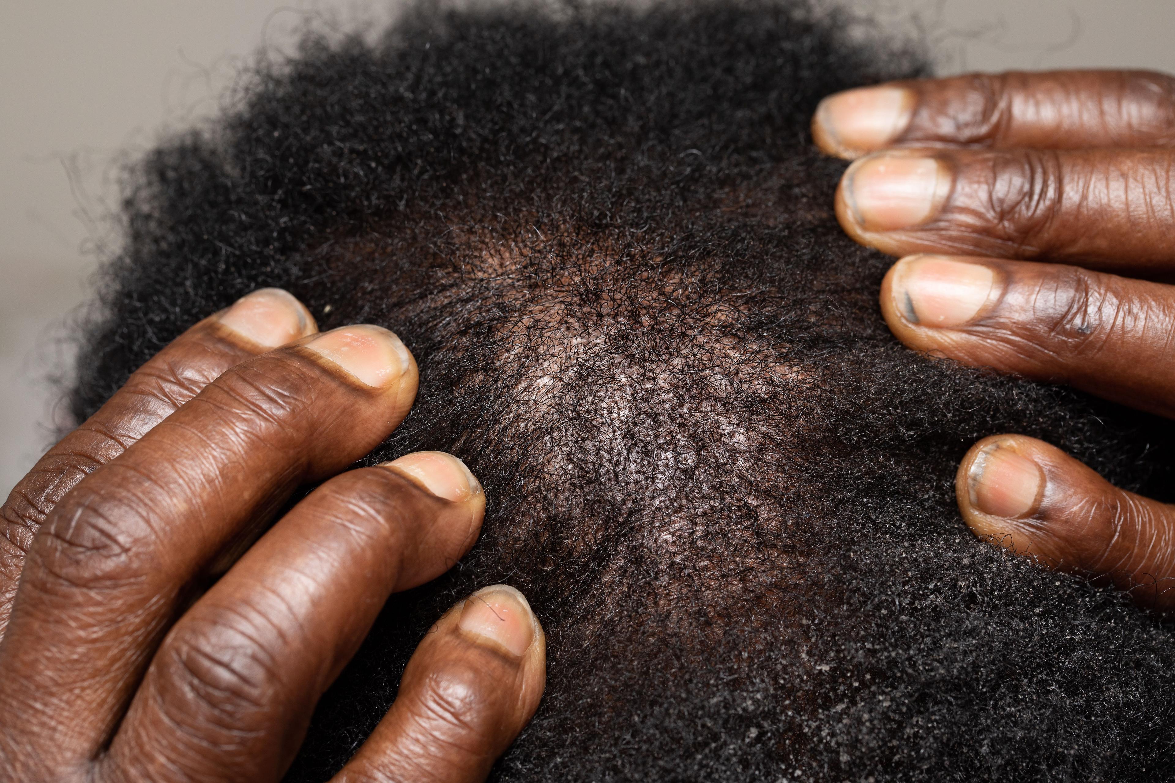 Thin hair loss on afro-american man scalp - Image credit: Alessandro Grandini | stock.adobe.com 